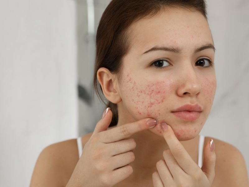 Tratamento Dermatologico para Acne em Curitiba