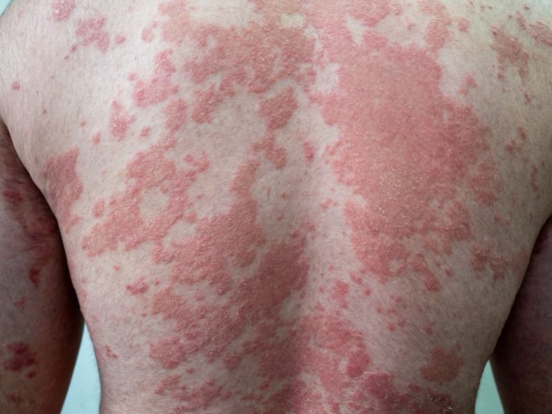 Tratamento Dermatologico para Psoriase em Curitiba