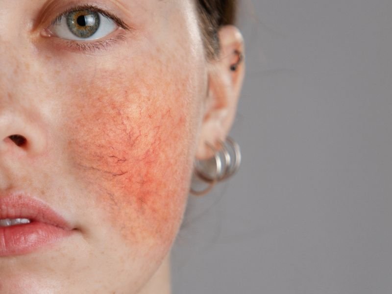 Tratamento Dermatologico para a Rosacea em Curitiba