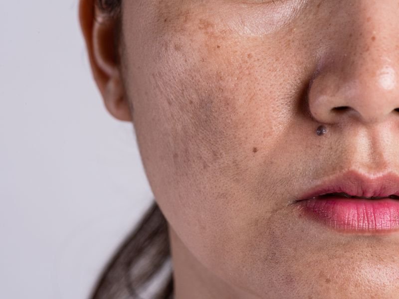Tratamento Dermatologico para o Melasma em Curitiba